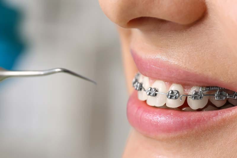 هزینه انواع ارتودنسی در غرب تهران چند است؟