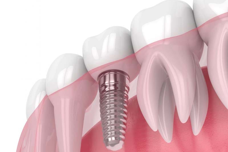 هزینه ایمپلنت ICX چند است؟