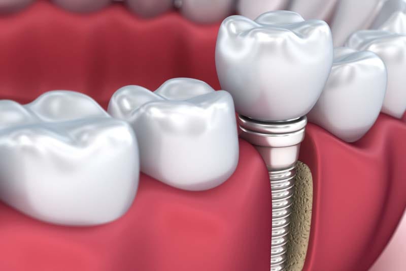 کاشت ایمپلنت ICX چه مراحلی دارد؟