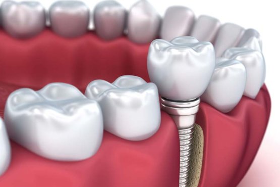کاشت ایمپلنت مدنتیکا شامل چند مرحله است؟