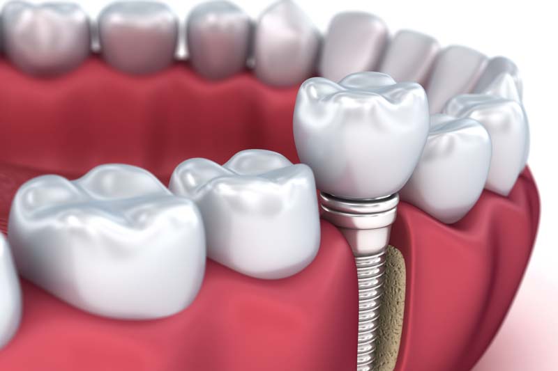 کاشت ایمپلنت مدنتیکا شامل چند مرحله است؟