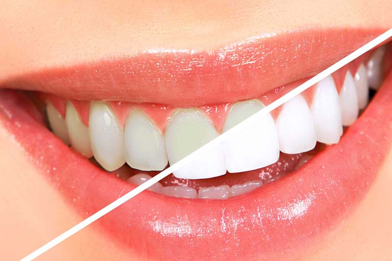 بلیچینگ دندان در غرب تهران