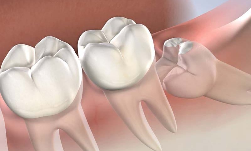 جراحی دندان عقل در غرب تهران