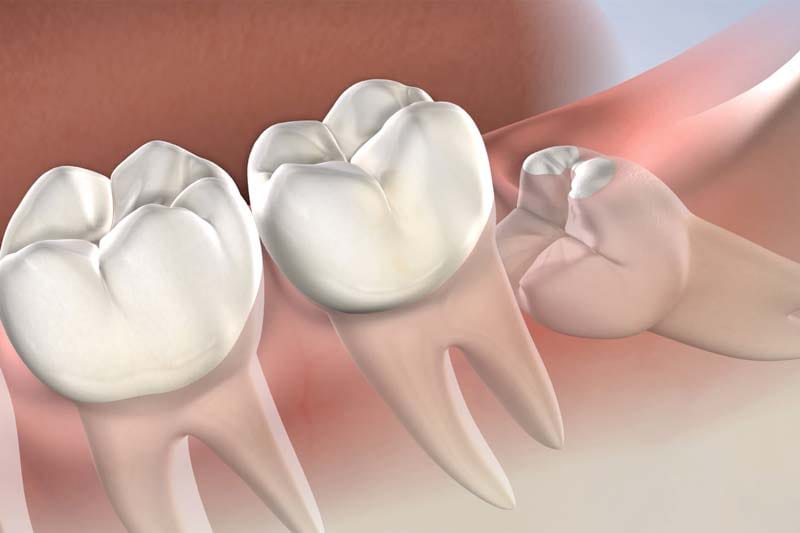 جراحی دندان عقل در غرب تهران