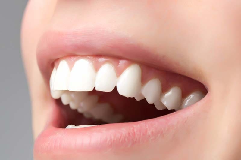 انواع روش های اصلاح طرح لبخند در غرب تهران و هزینه های آن