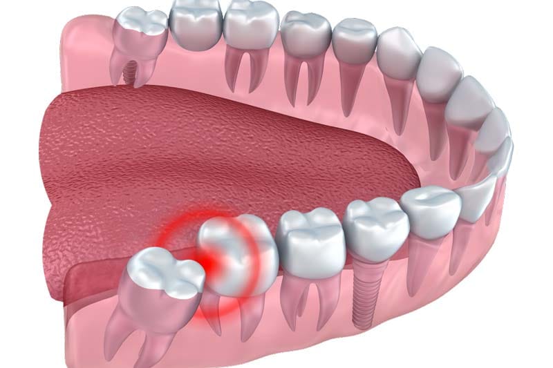 انواع روش های جراحی دندان عقل