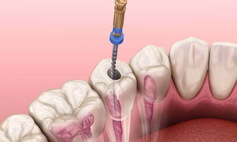 درمان ریشه دندان در غرب تهران