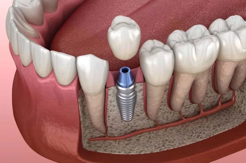 ایمپلنت سوئیسی TR و فیکسچر های آن