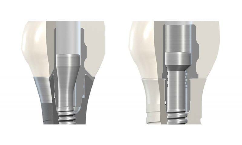 ایمپلنت سوئیسی آی تی آی ITI