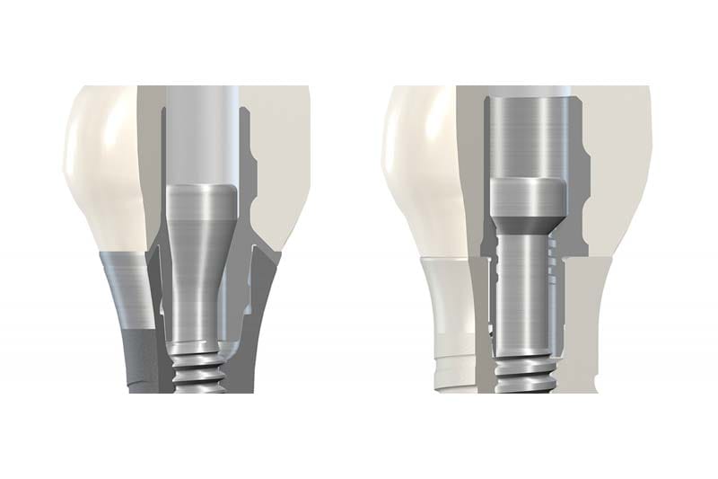 ایمپلنت سوئیسی آی تی آی ITI
