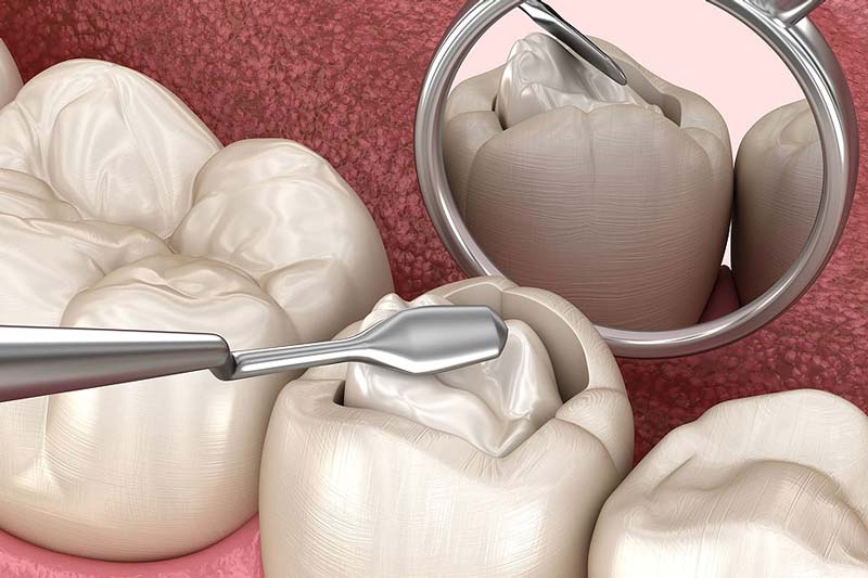 چه عواملی بر هزینه نهایی پر کردن دندان تاثیر می گذارد؟