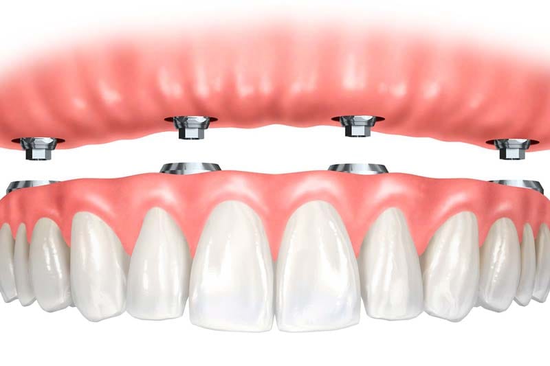 ایمپلنت مدنتیکا Medentika و فیکسچر های آن