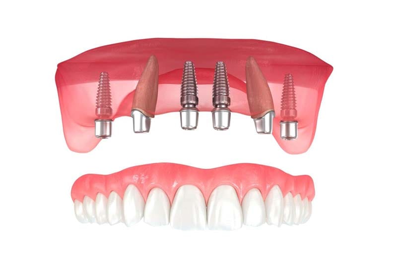 چه مراحلی باید برای کاشت ایمپلنت آلفادنت طی شود؟