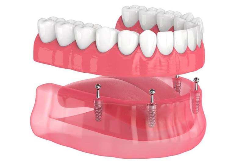 عوامل موثر بر هزینه ایمپلنت برند بگو چیست؟