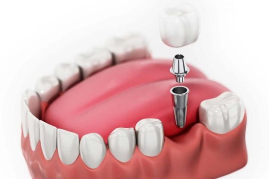 فیکسچر های ایمپلنت ITI چه ویژگی هایی دارد؟