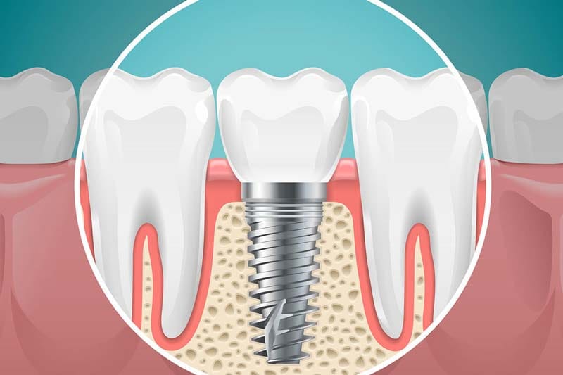 فیکسچر های ایمپلنت ای سی ایکس