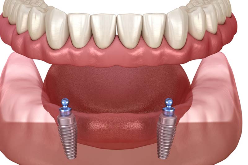مراقبت های پس از کاشت ایمپلنت مدنتیکا