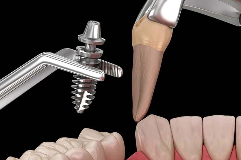 مزایا و معایب امپلنت بگو آلمانی چیست؟