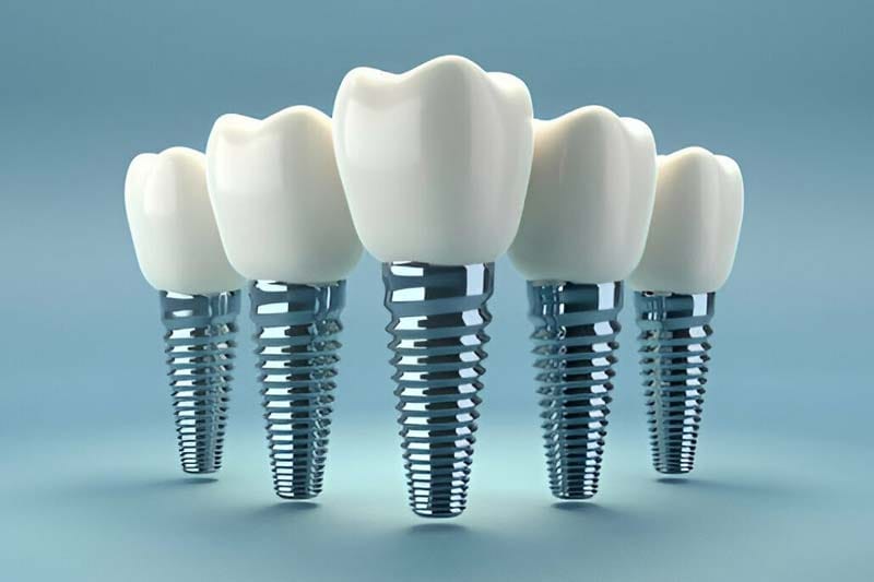 مزایا و معایب ایمپلنت SIC 