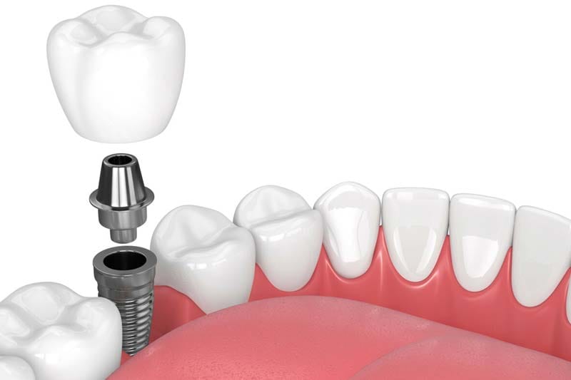 مزایا و معایب ایمپلنت آلمانی زایو xive چیست؟