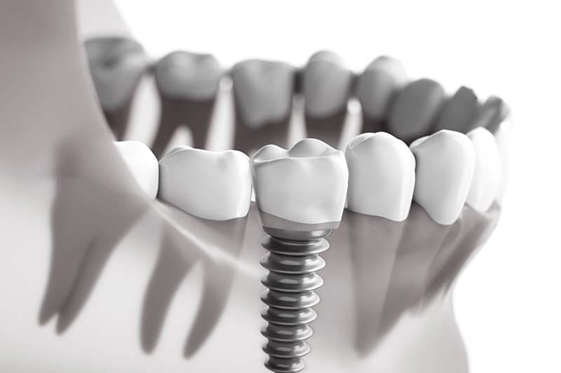 مراقبتهای پس از درمان ایمپلنت بایوهورایزن