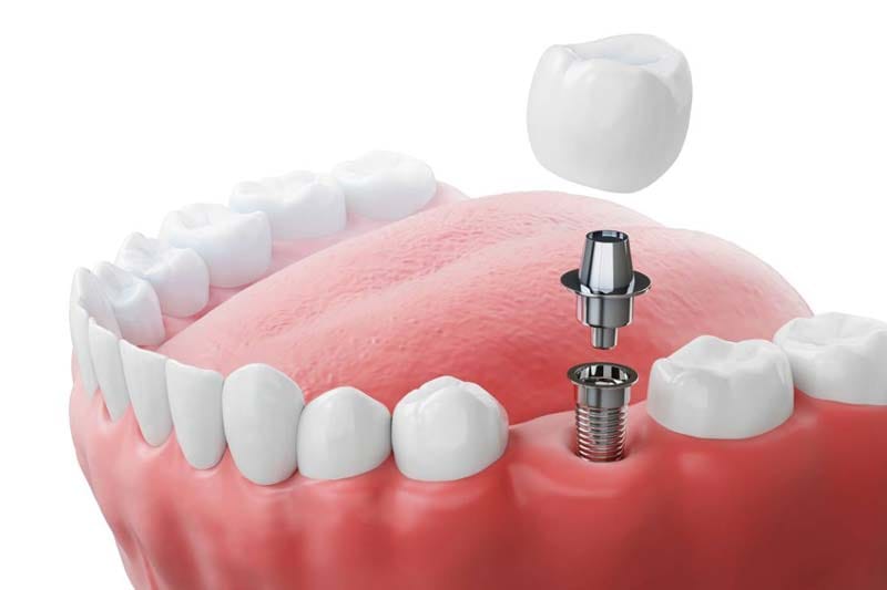 مراقبتهای پس از درمان ایمپلنت دندان سوئیسی TRI