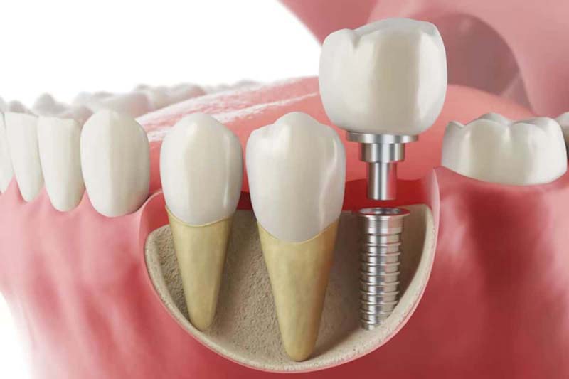 مراقبت‌های پس از درمان ایمپلنت زایو Xive