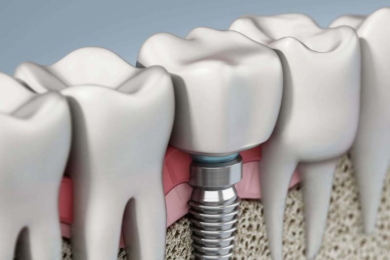 مراقبتهای پس از درمان ایمپلنت نوبل بیوکر