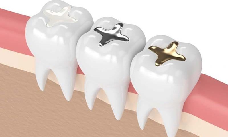 پر کردن دندان در غرب تهران