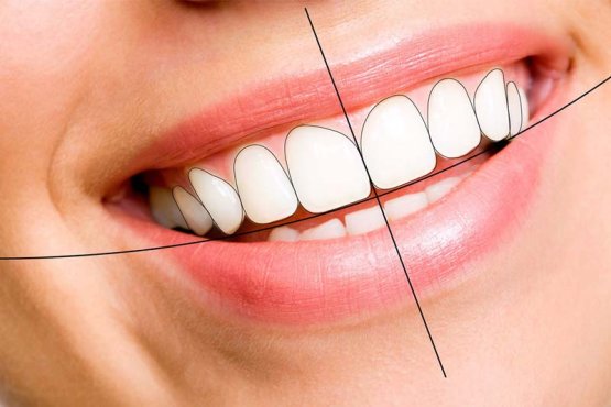 هزینه اصلاح طرح لبخند چند است؟