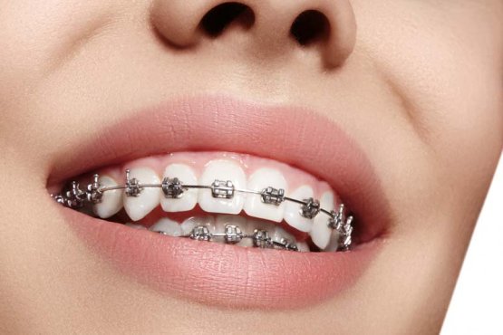 مراحل انجام ارتودنسی دندان چیست؟