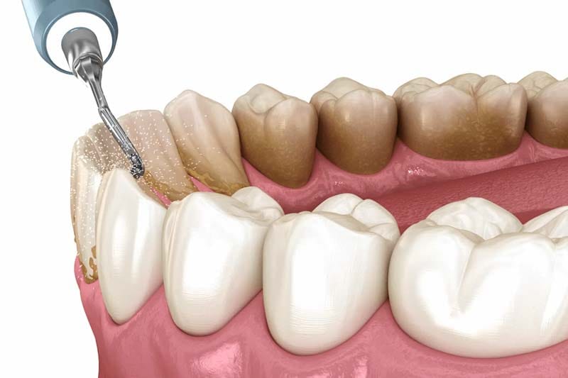 مراحل انجام عصب کشی چیست؟