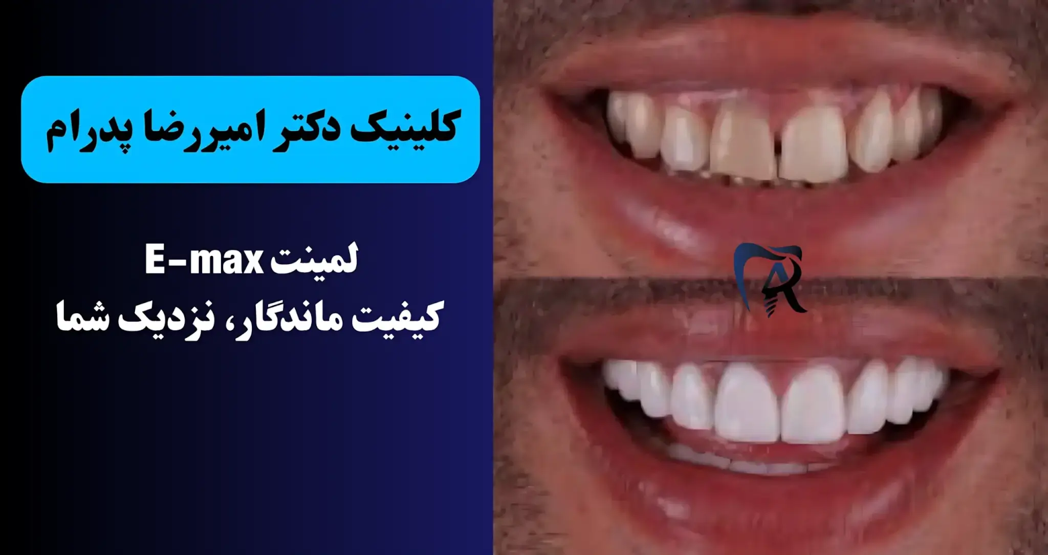بنر نمونه کار لمینت دندان در صادقیه تهران - کلینیک دکتر امیررضا پدرام