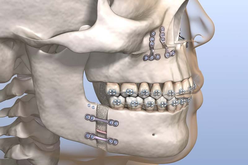 چرا به جراحی فک و صورت نیاز داریم؟