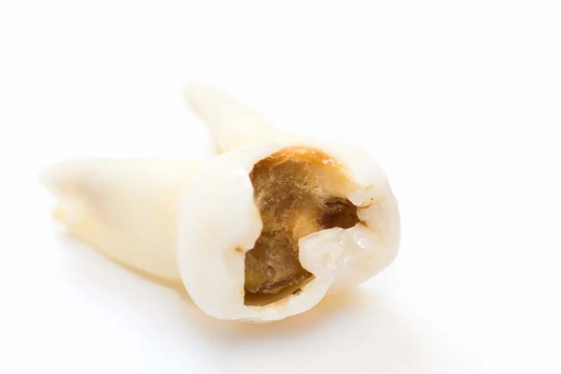 آیا بیمه هزینه ترمیم دندان پوسیده را قبول می کند؟