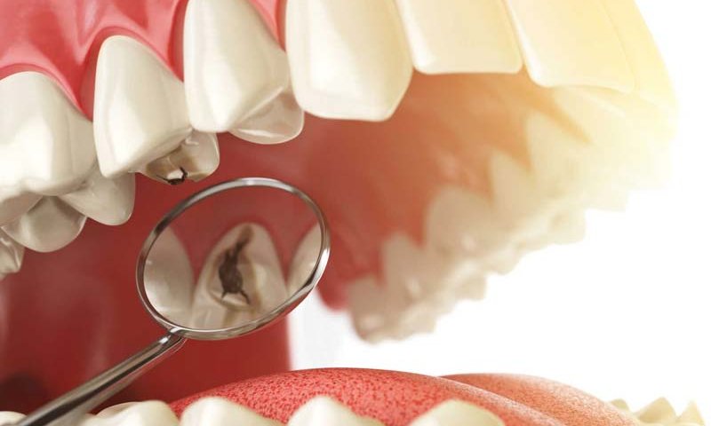 هزینه ترمیم دندان پوسیده