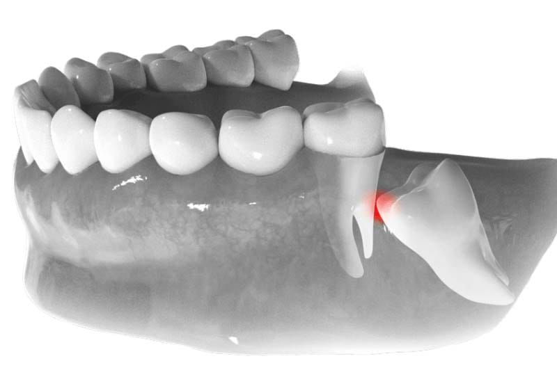هزینه جراحی دندان عقل در صادقیه تهران چند است؟