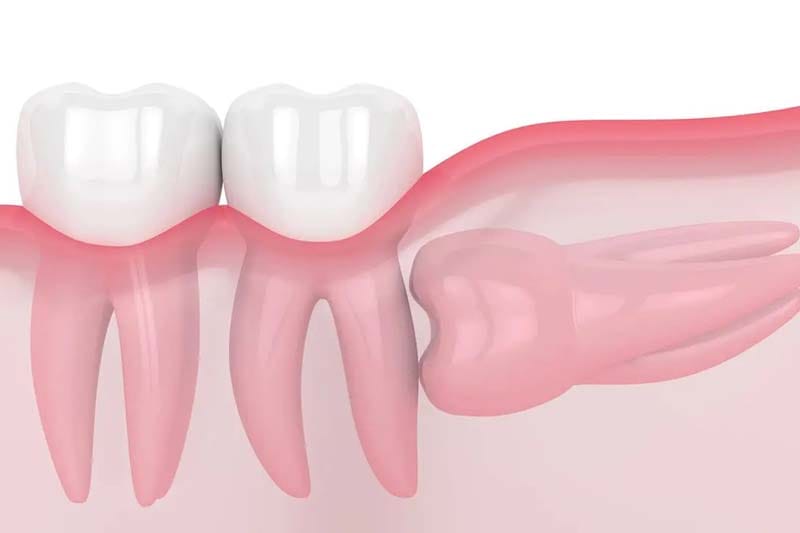 مراحل جراحی دندان عقل در صادقیه تهران