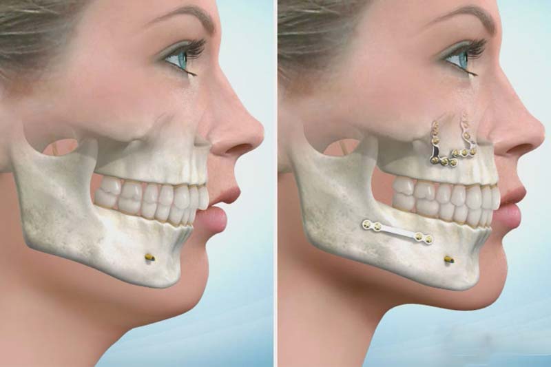 هزینه جراحی فک و صورت چند است؟