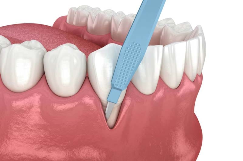 مراحل جراحی لثه در کلینیک دکتر پدرام