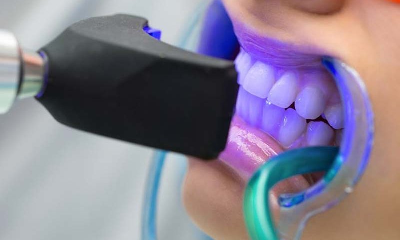 بلیچینگ دندان در صادقیه تهران