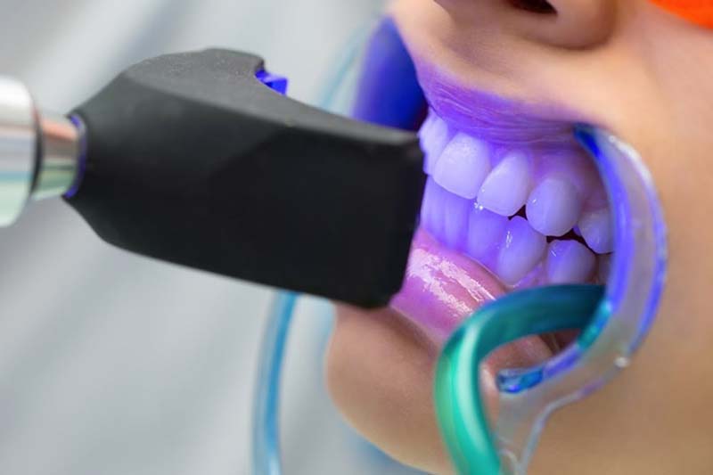 بلیچینگ دندان در صادقیه تهران