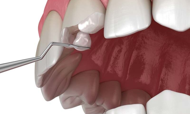 کامپوزیت دندان در صادقیه تهران