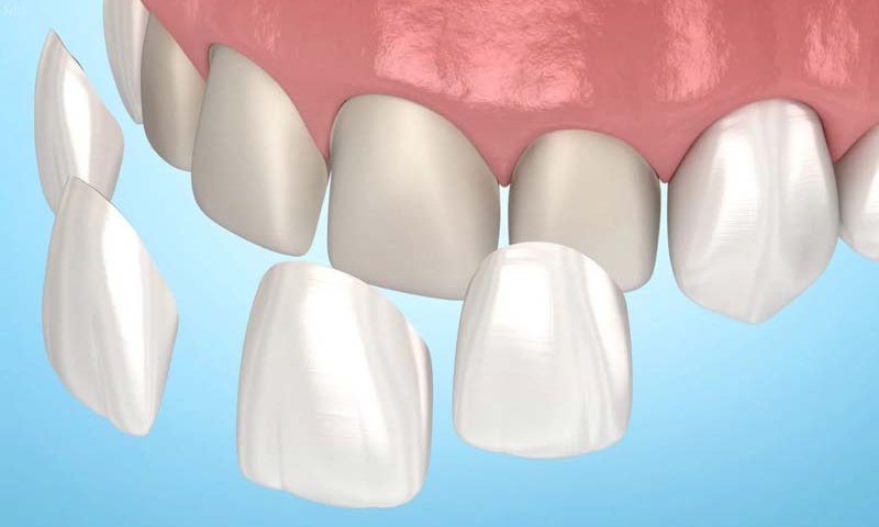 کامپوزیت دندان در غرب تهران