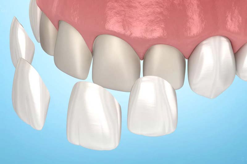 کامپوزیت دندان در غرب تهران