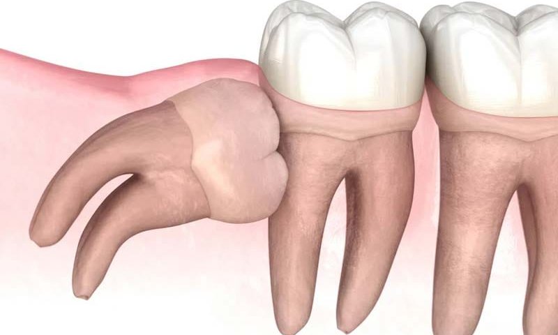 جراحی دندان عقل در صادقیه تهران