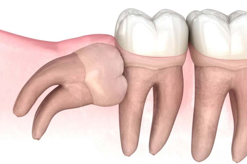 جراحی دندان عقل در صادقیه تهران