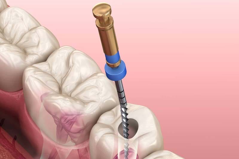 چند روش عصب کشی دندان داریم؟