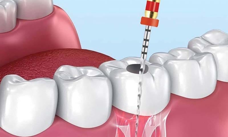 درمان ریشه دندان در صادقیه تهران