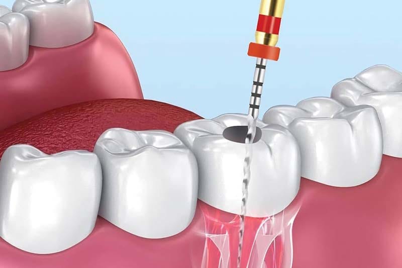 درمان ریشه دندان در صادقیه تهران